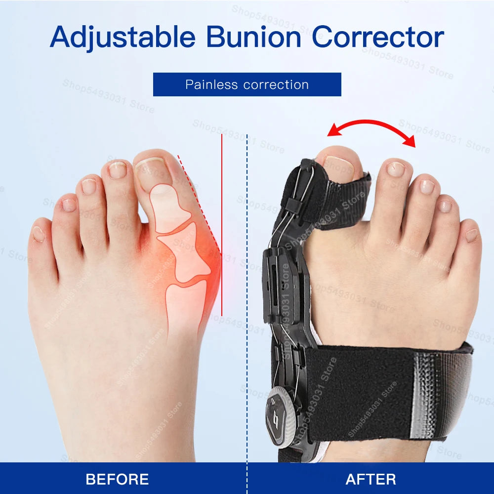 Adjustable Bunion Corrector – Hallux Valgus Toe Straightener with Rotating Knob, Toe Separator & Soft Silicone Pad