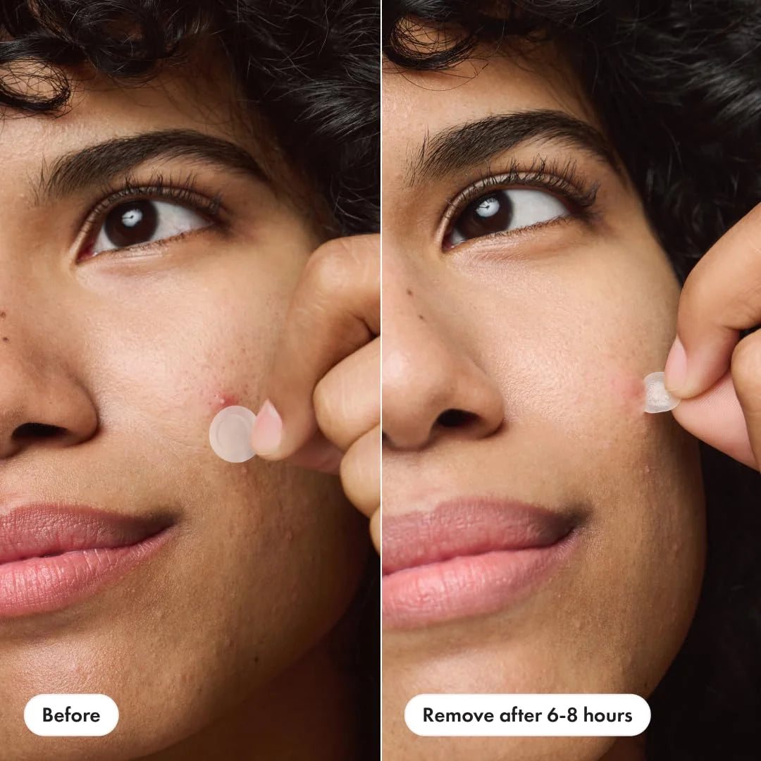 Acne Invisible Patch Set for Day and Night – Discreet Blemish Cover for Face and Skin